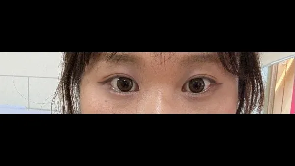 自然癒着法, 目つき矯正 — RE&RE PLASTIC SURGERY 5