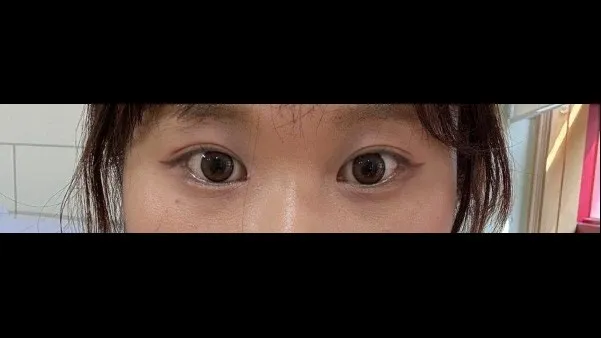 自然癒着法, 目つき矯正 — RE&RE PLASTIC SURGERY 6