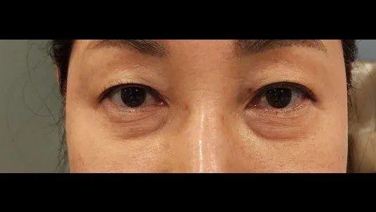 Sub-brow Lift, Lower Blepharoplasty (Aging Eye Rejuvenation) — RE&RE PLASTIC SURGERY 1