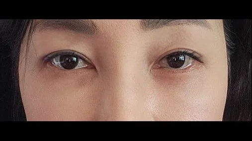 Sub-brow Lift, Lower Blepharoplasty (Aging Eye Rejuvenation) — RE&RE PLASTIC SURGERY 2