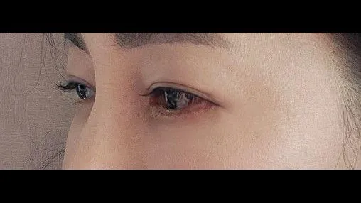 Sub-brow Lift, Lower Blepharoplasty (Aging Eye Rejuvenation) — RE&RE PLASTIC SURGERY 3