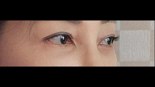 Sub-brow Lift, Lower Blepharoplasty (Aging Eye Rejuvenation) — RE&RE PLASTIC SURGERY 4