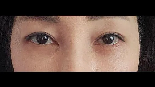 Sub-brow Lift, Lower Blepharoplasty (Aging Eye Rejuvenation) — RE&RE PLASTIC SURGERY 5