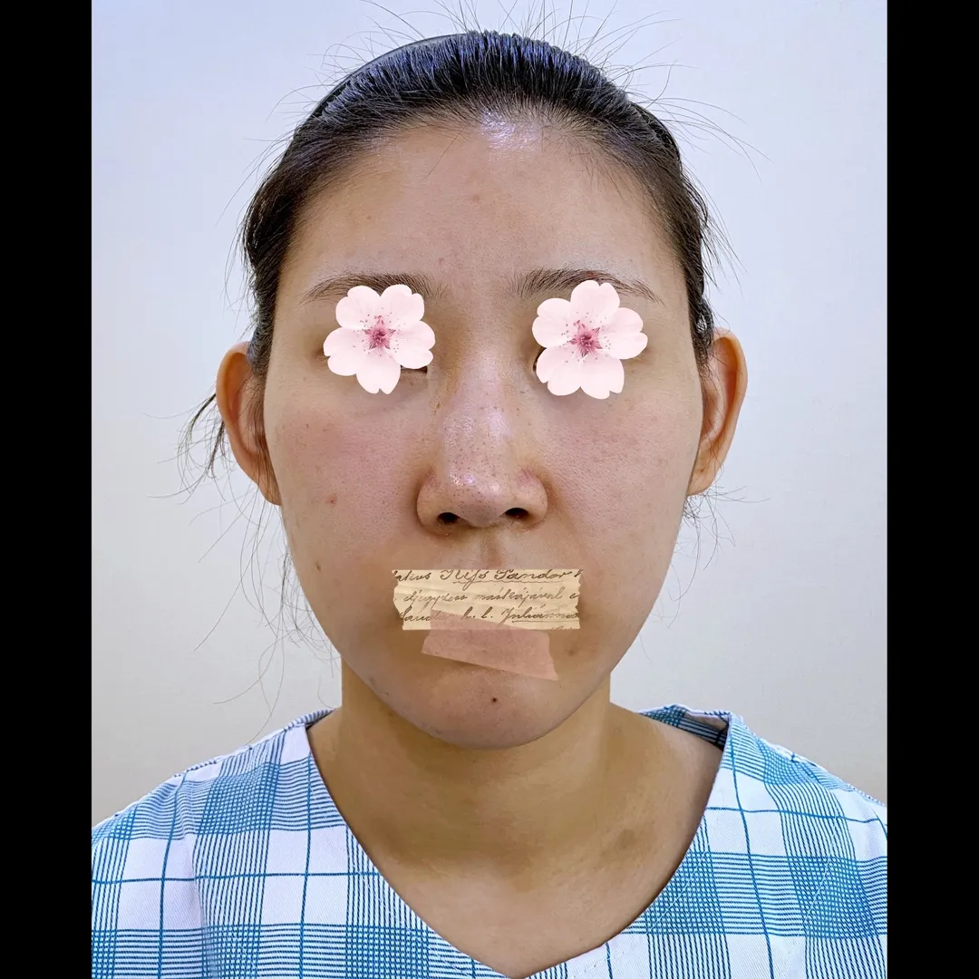 Hump Nose, Autologous Tissue, Rhinoplasty Revision 1