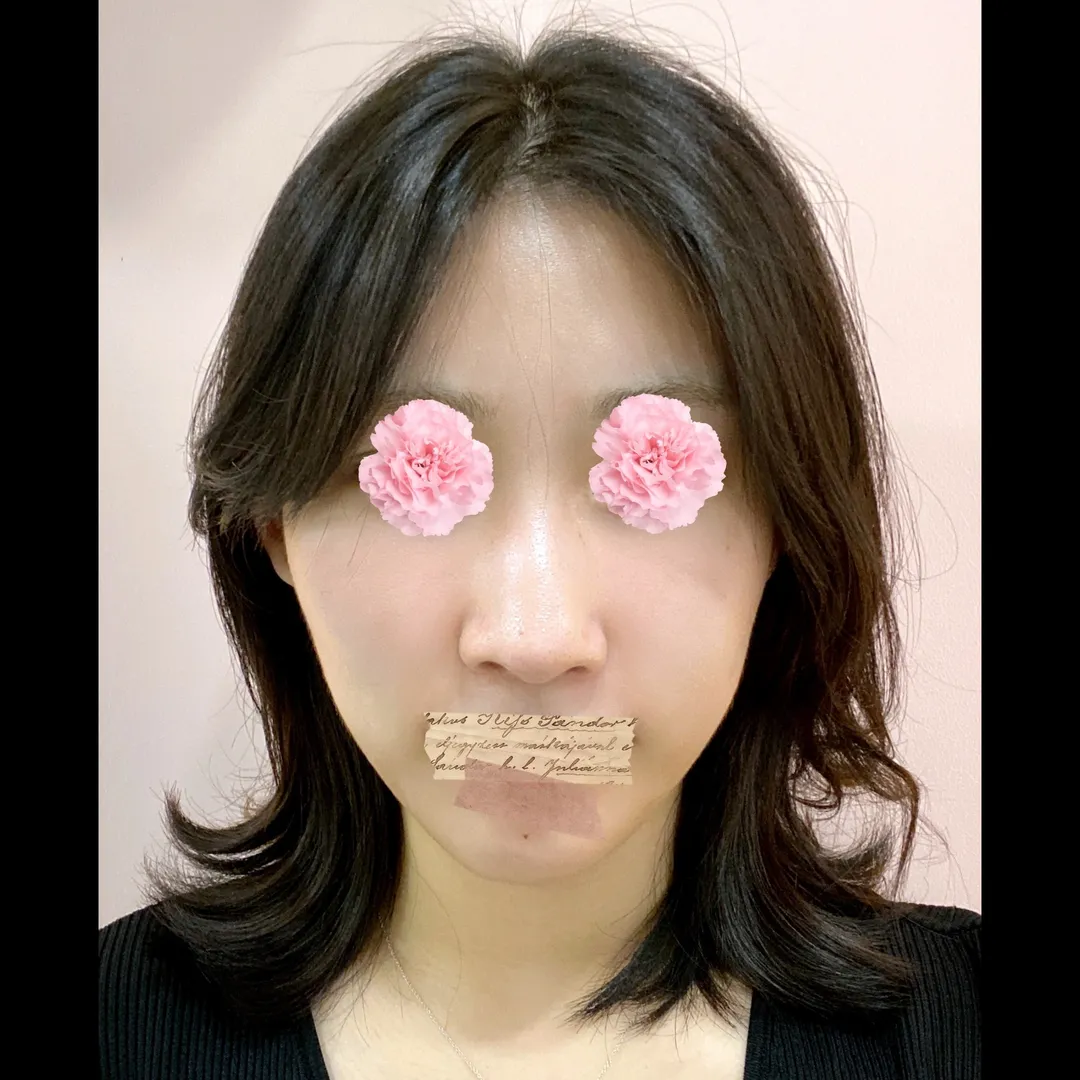 Hump Nose, Autologous Tissue, Rhinoplasty Revision 2
