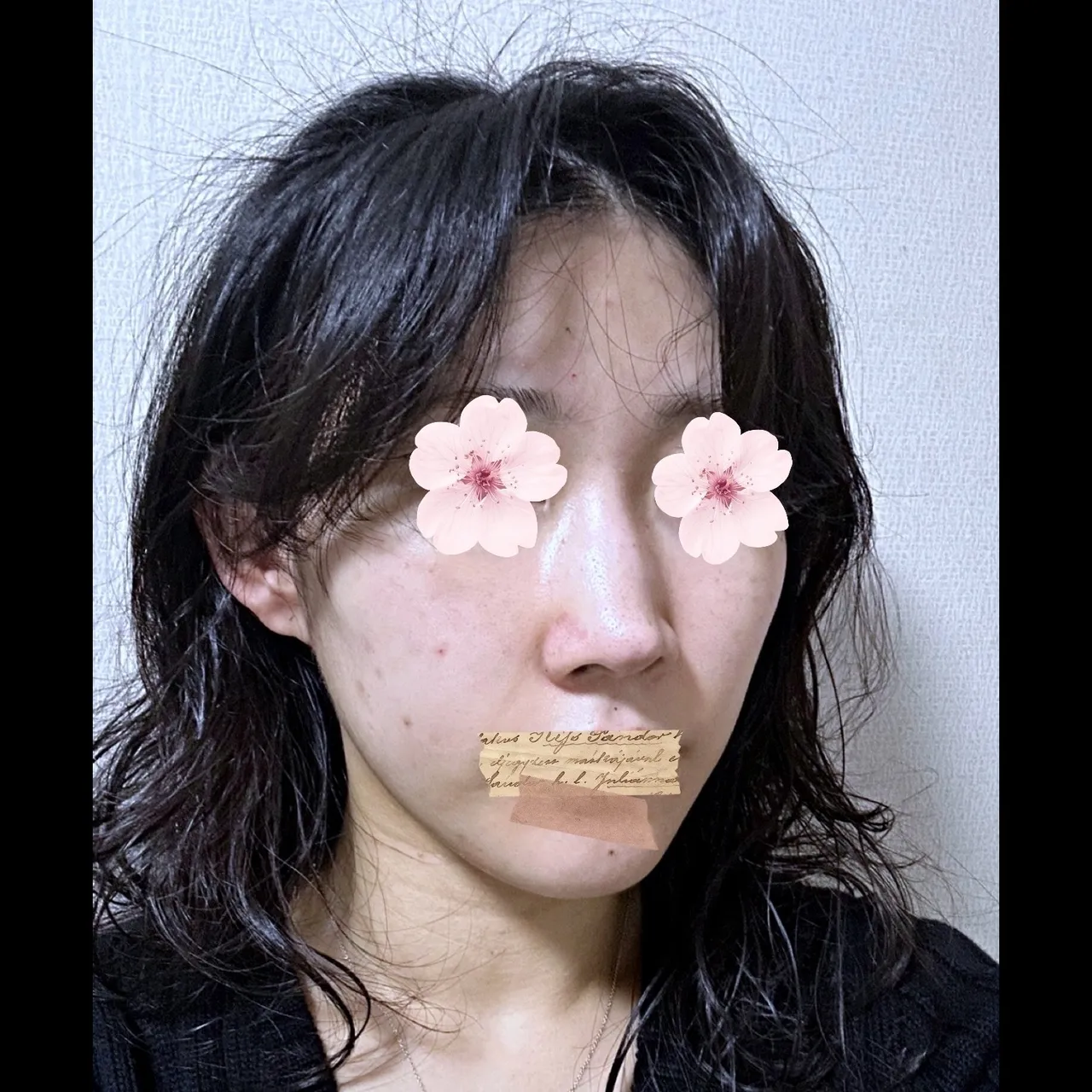 Hump Nose, Autologous Tissue, Rhinoplasty Revision — Yerom Plastic Surgery 3