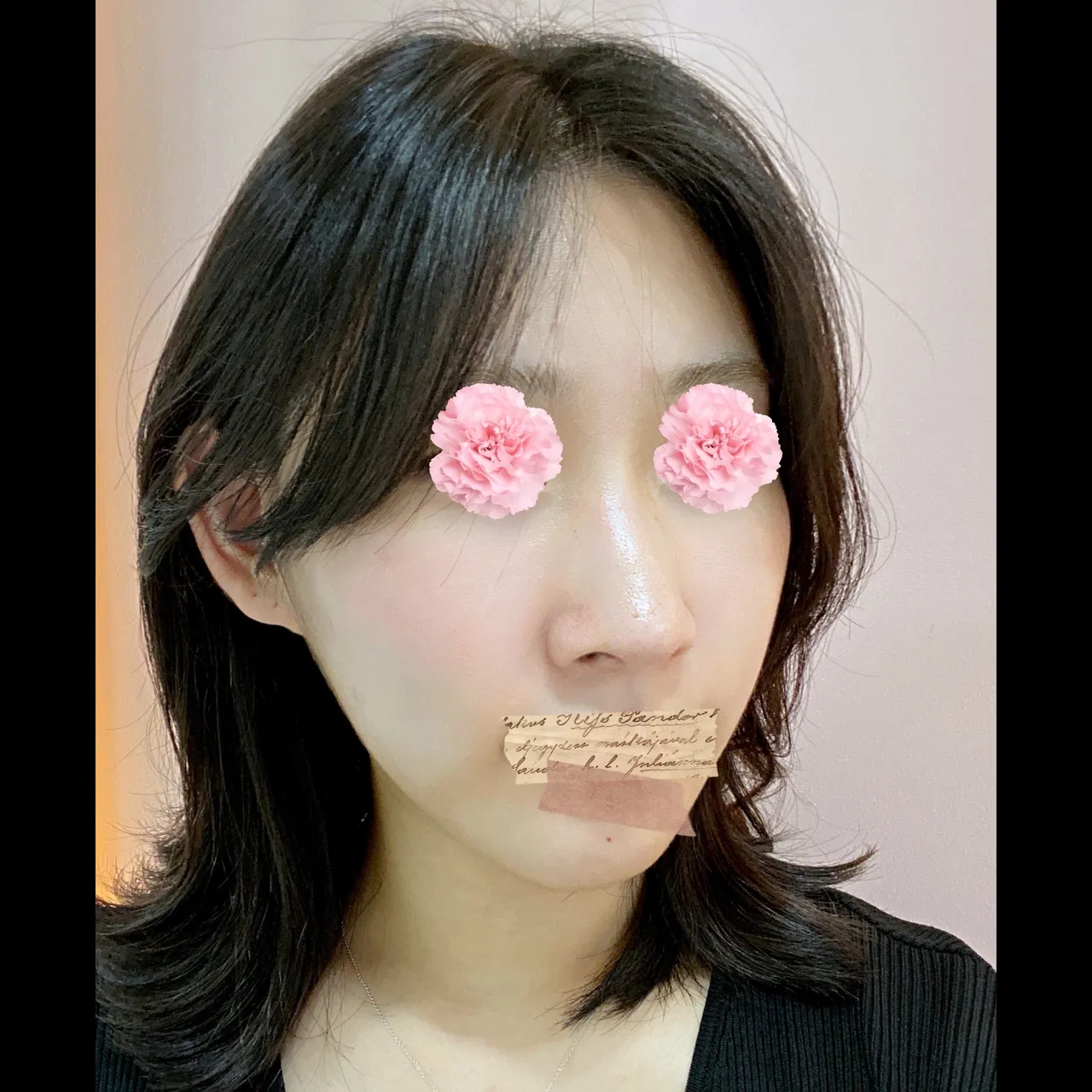 Hump Nose, Autologous Tissue, Rhinoplasty Revision — Yerom Plastic Surgery 4