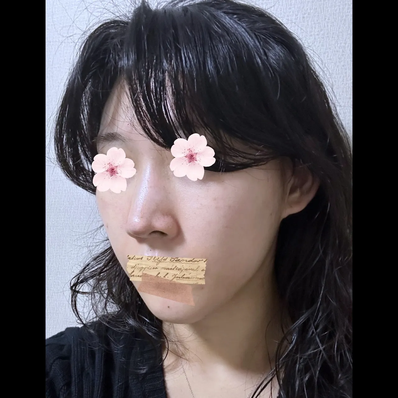 Hump Nose, Autologous Tissue, Rhinoplasty Revision — Yerom Plastic Surgery 5