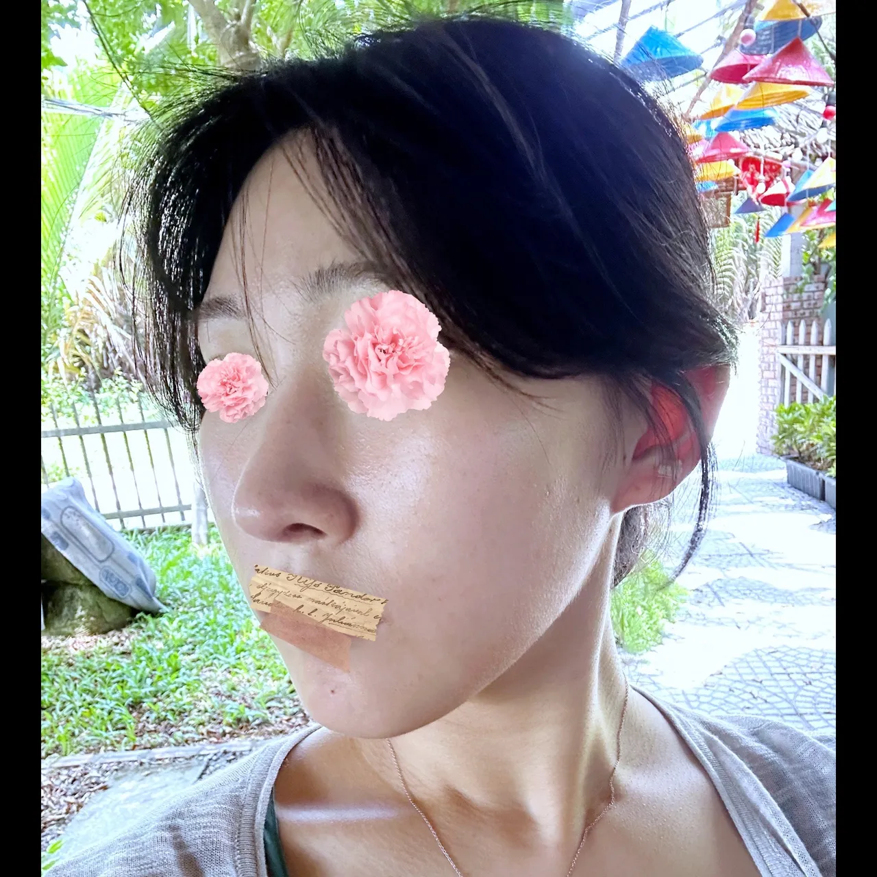 Hump Nose, Autologous Tissue, Rhinoplasty Revision — Yerom Plastic Surgery 6