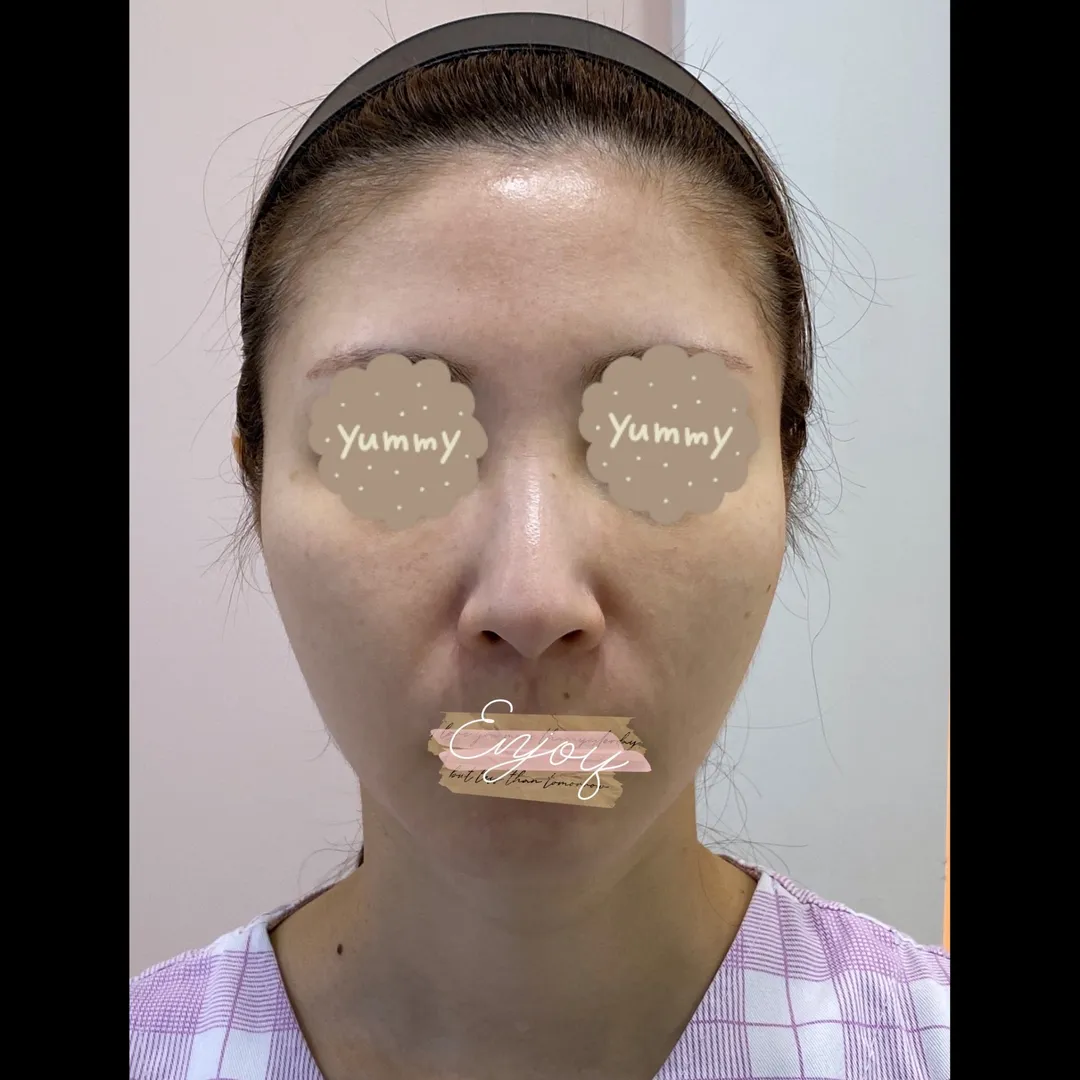 Hump Nose, Long Nose 1