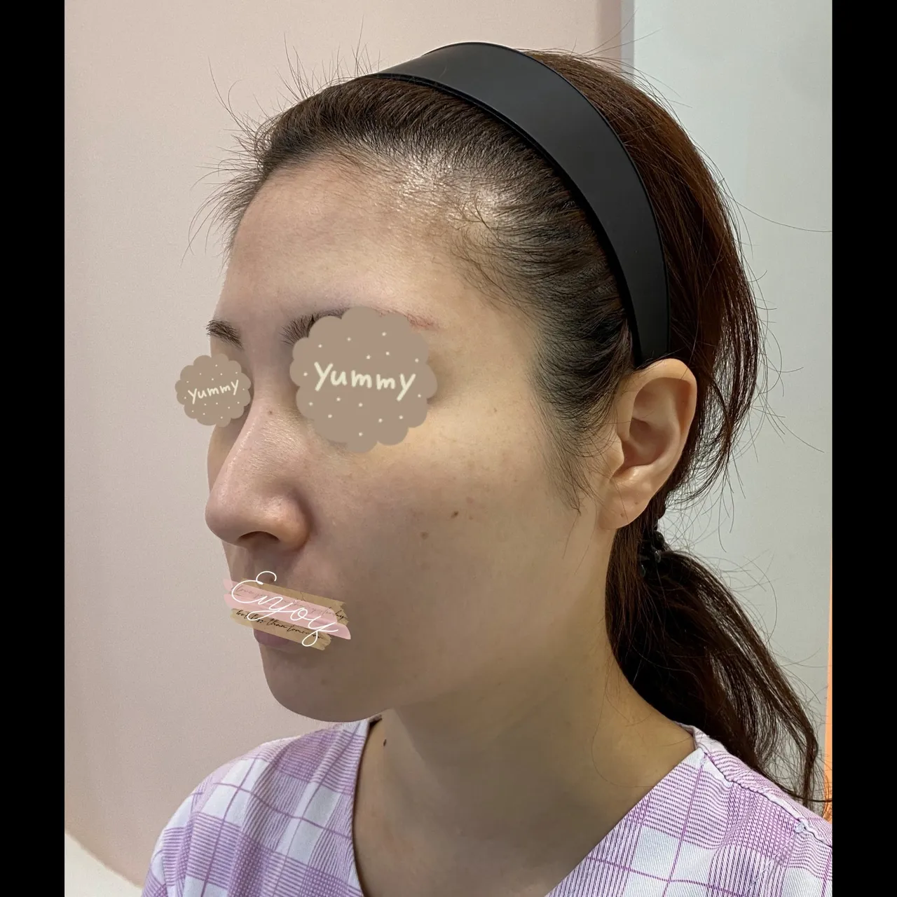 Hump Nose, Long Nose — Yerom Plastic Surgery 3