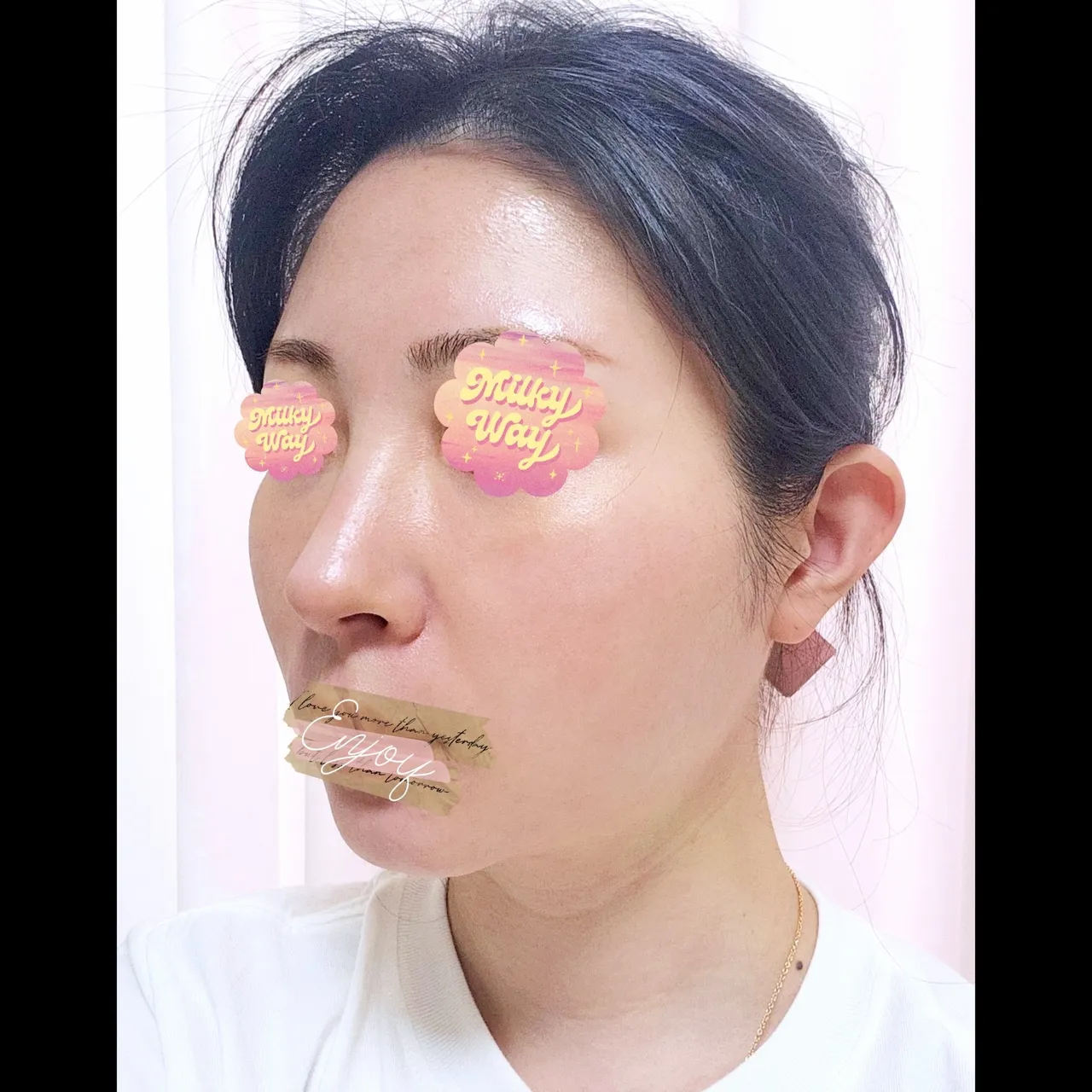 Hump Nose, Long Nose — Yerom Plastic Surgery 4