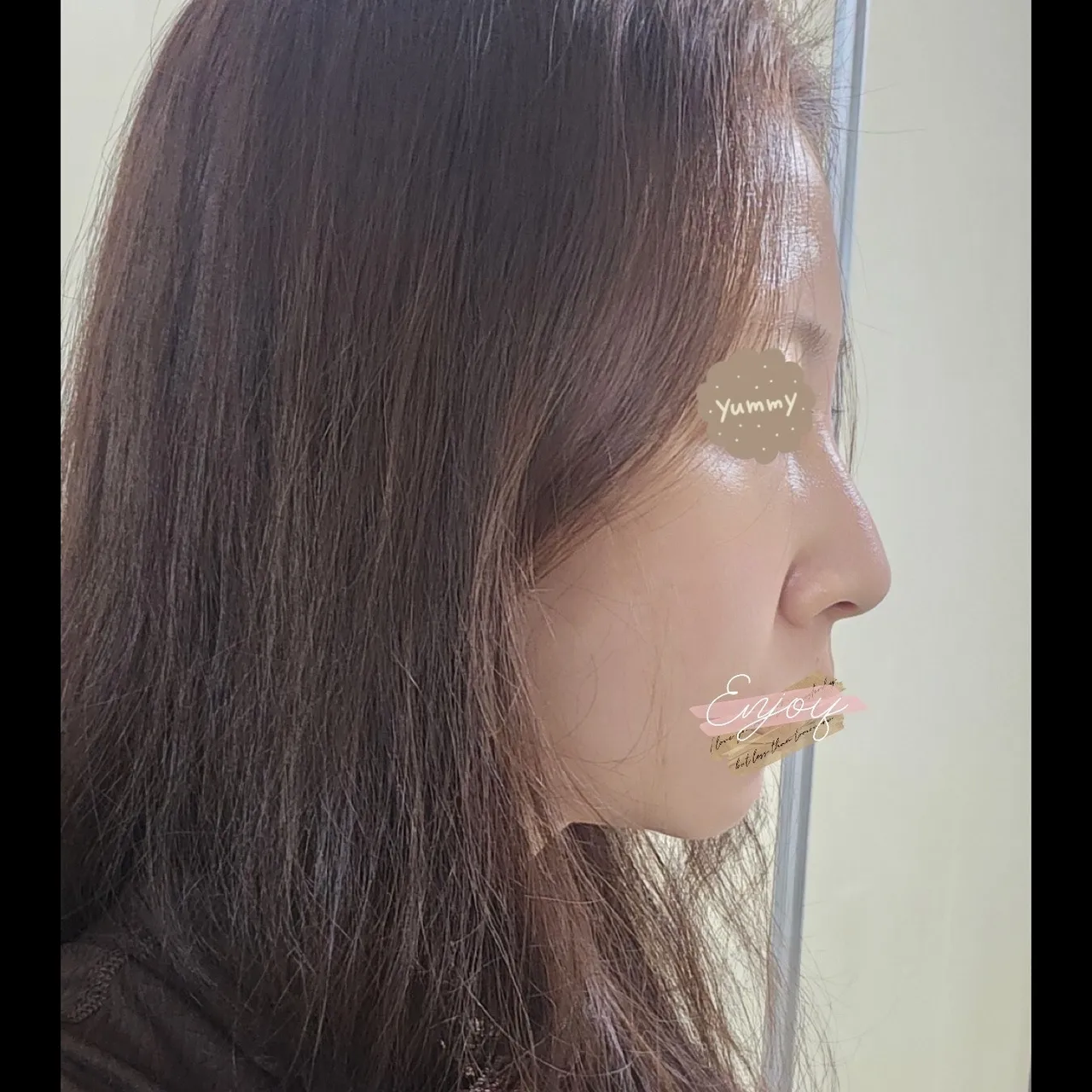 Hump Nose, Long Nose — Yerom Plastic Surgery 5