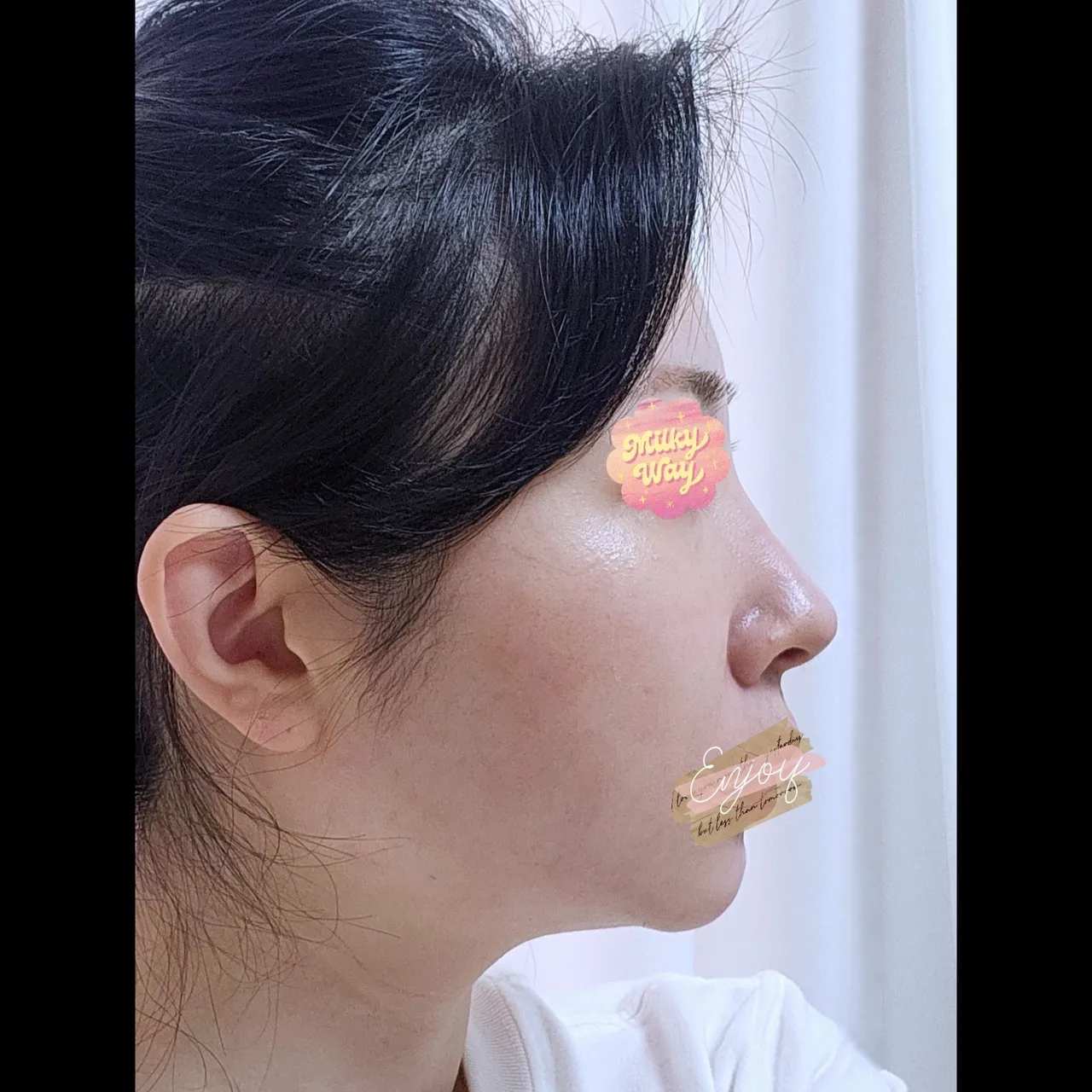 Hump Nose, Long Nose — Yerom Plastic Surgery 6
