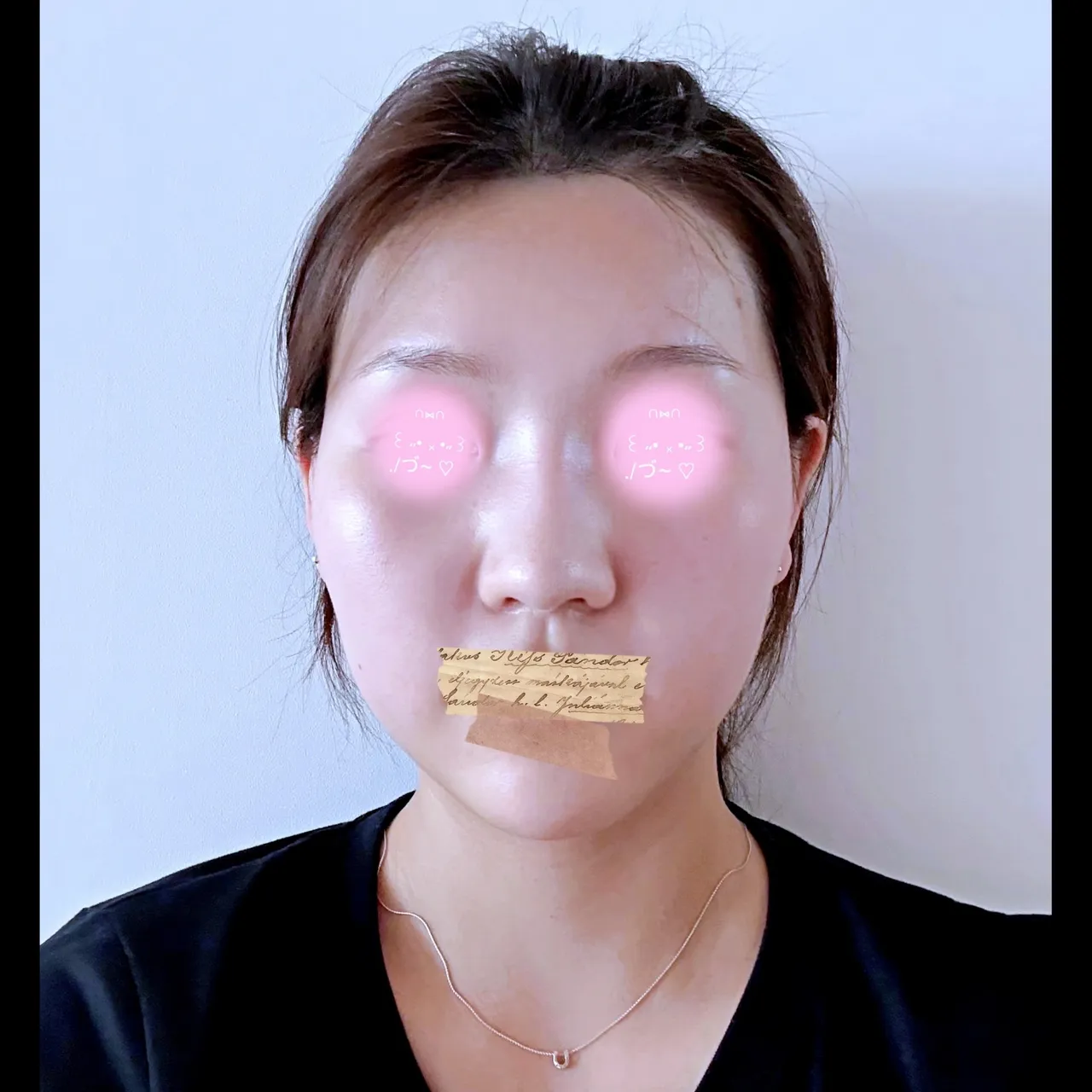 Low Bridge Nose — Yerom Plastic Surgery 2