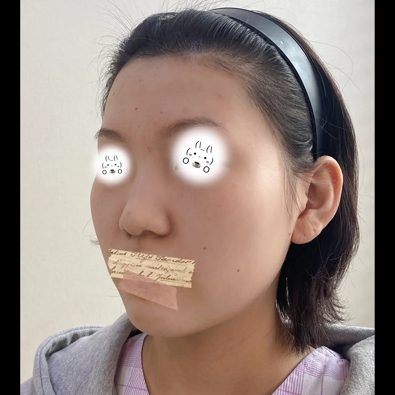 Low Bridge Nose — Yerom Plastic Surgery 3