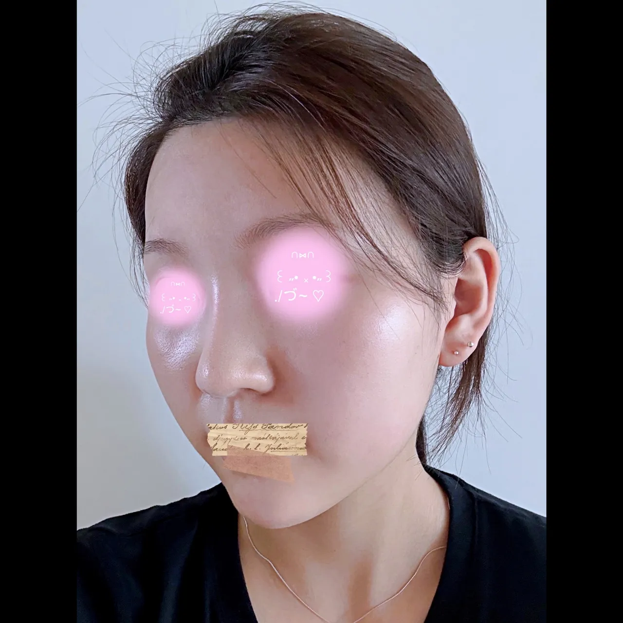 Low Bridge Nose — Yerom Plastic Surgery 4