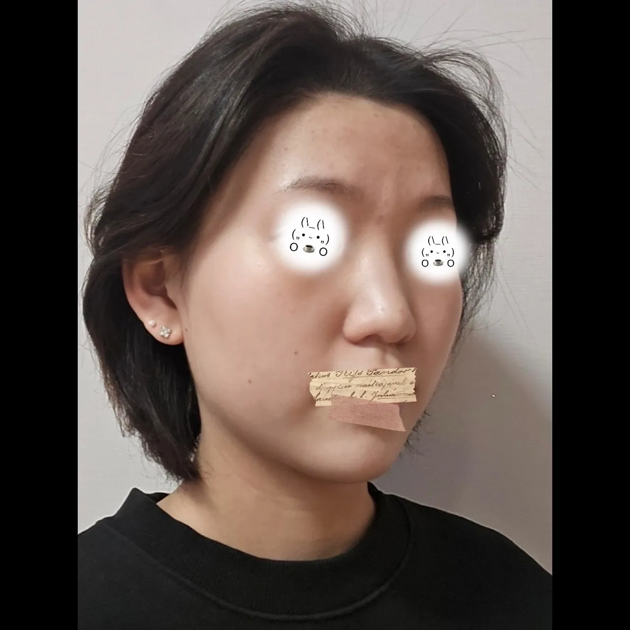 Low Bridge Nose — Yerom Plastic Surgery 5