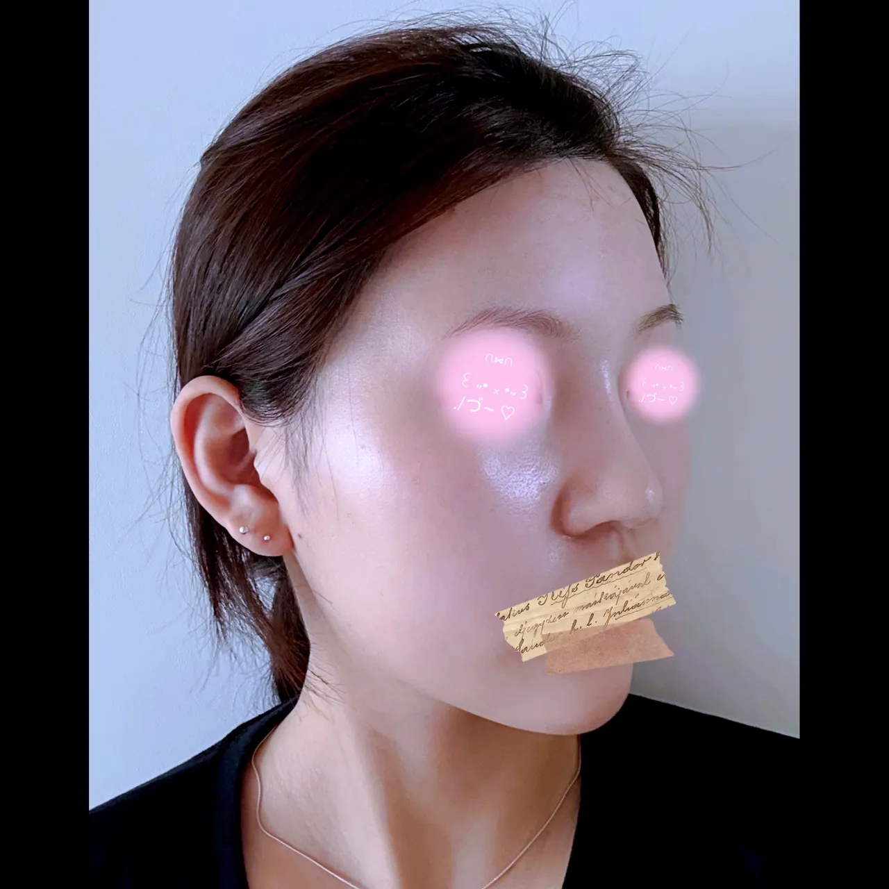 Low Bridge Nose — Yerom Plastic Surgery 6