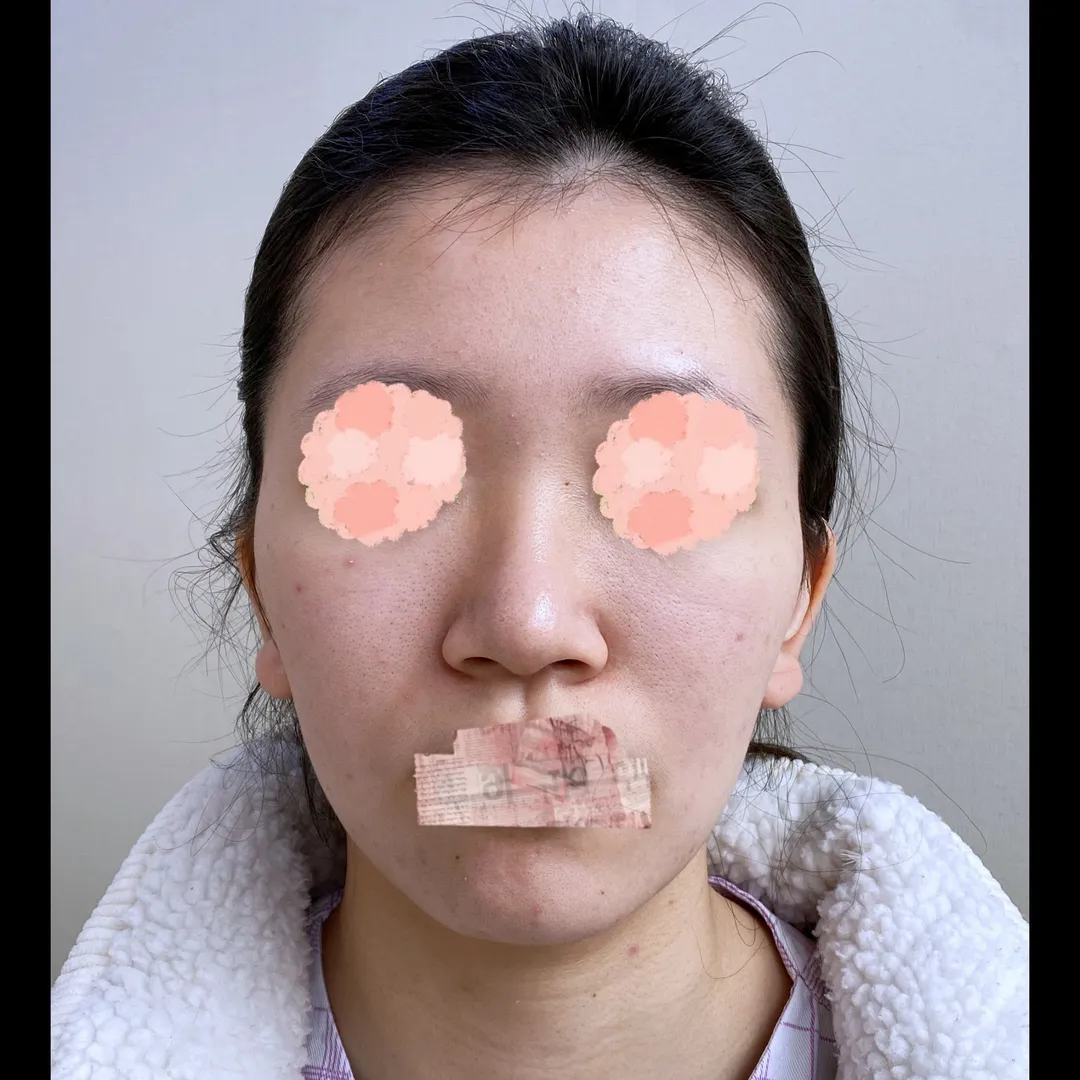 Bulbous Nose, Alar Base Reduction 1