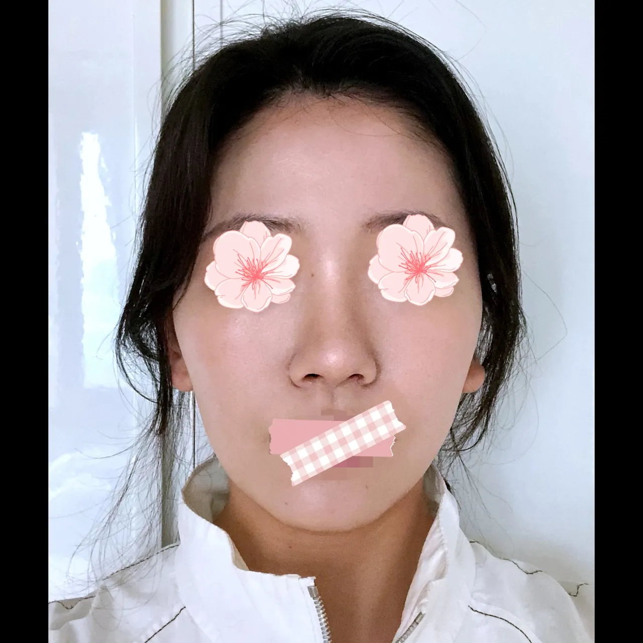 Bulbous Nose, Alar Base Reduction — Yerom Plastic Surgery 2