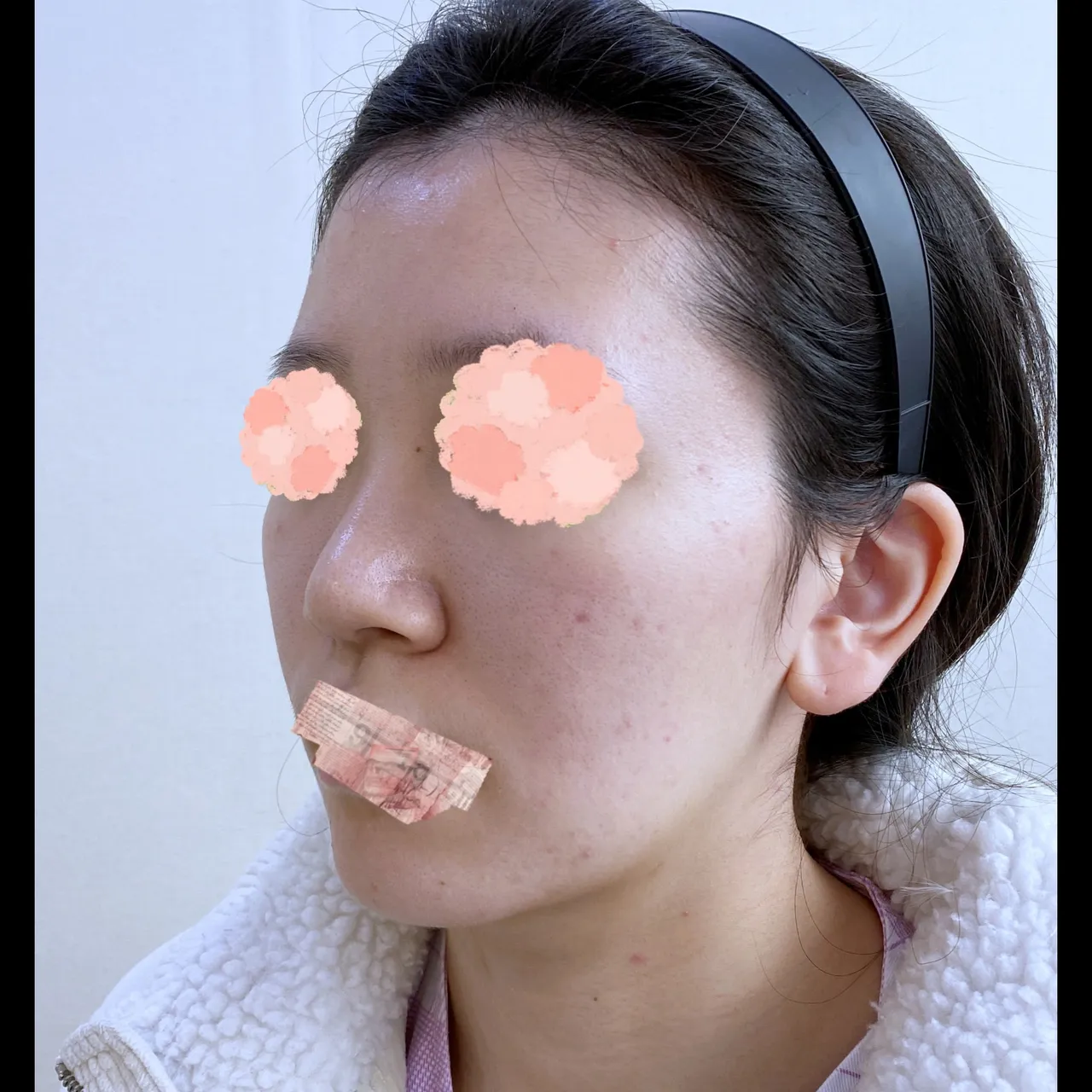 Bulbous Nose, Alar Base Reduction — Yerom Plastic Surgery 3