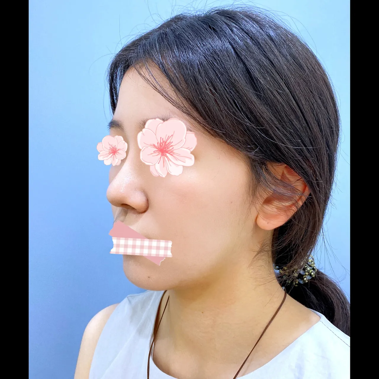 Bulbous Nose, Alar Base Reduction — Yerom Plastic Surgery 4