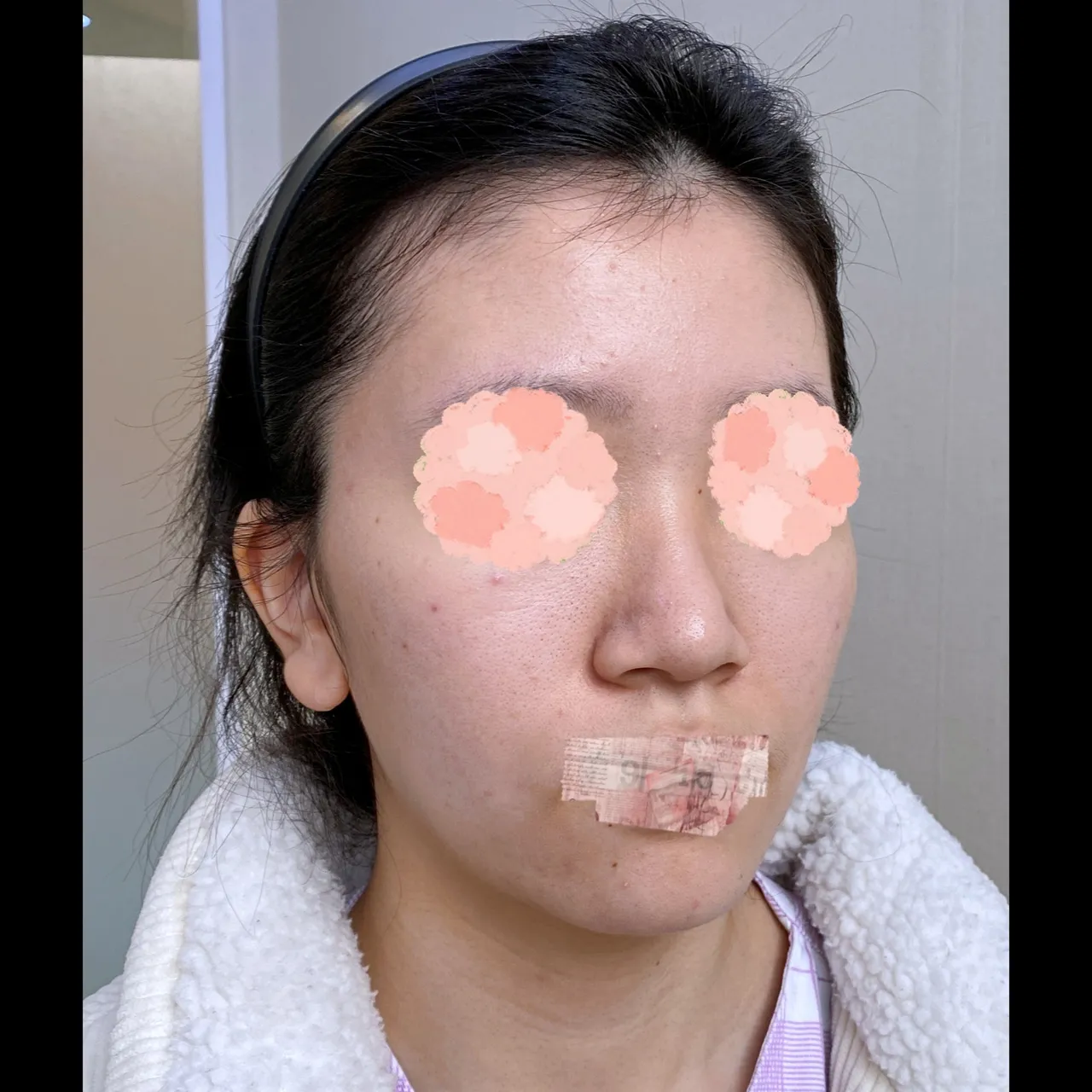 Bulbous Nose, Alar Base Reduction — Yerom Plastic Surgery 5