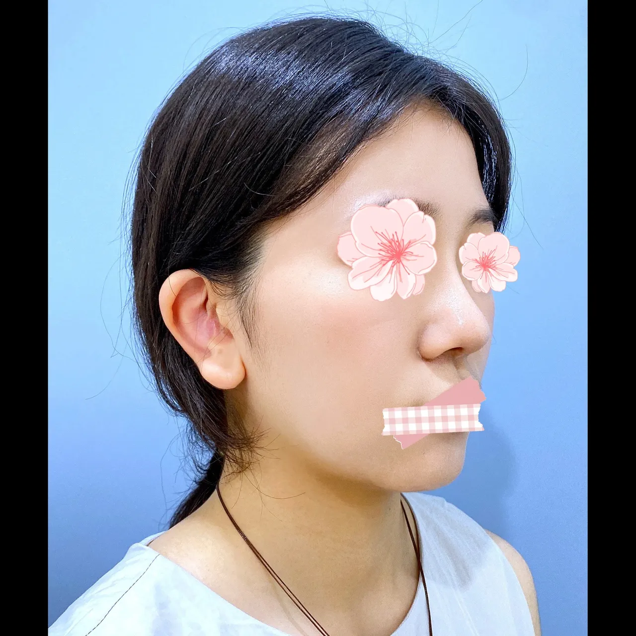 Bulbous Nose, Alar Base Reduction — Yerom Plastic Surgery 6