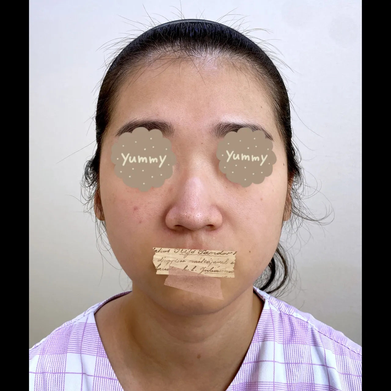 Low Bridge Nose, Crooked Nose, Hump Nose — Yerom Plastic Surgery 1