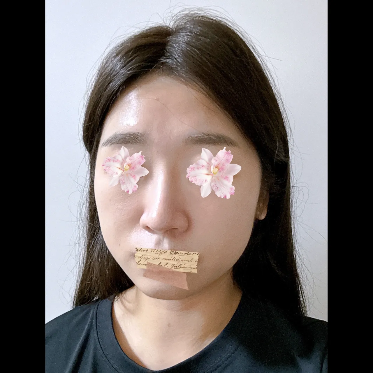 Low Bridge Nose, Crooked Nose, Hump Nose — Yerom Plastic Surgery 2