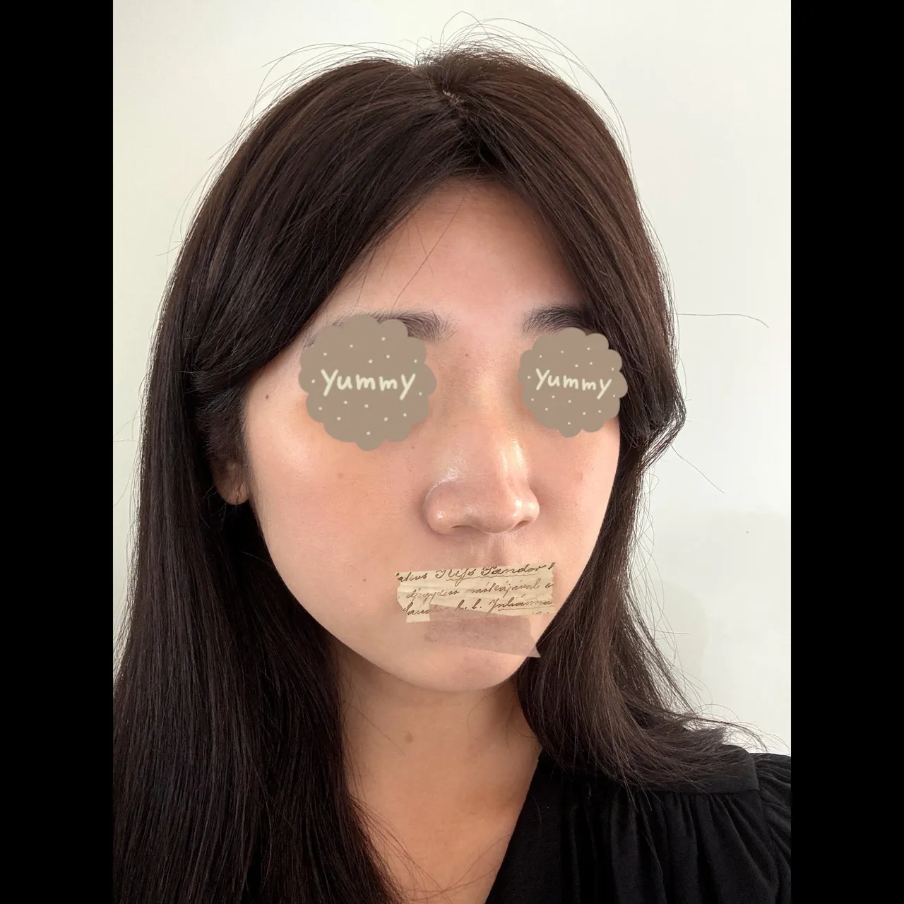 Low Bridge Nose, Crooked Nose, Hump Nose — Yerom Plastic Surgery 3