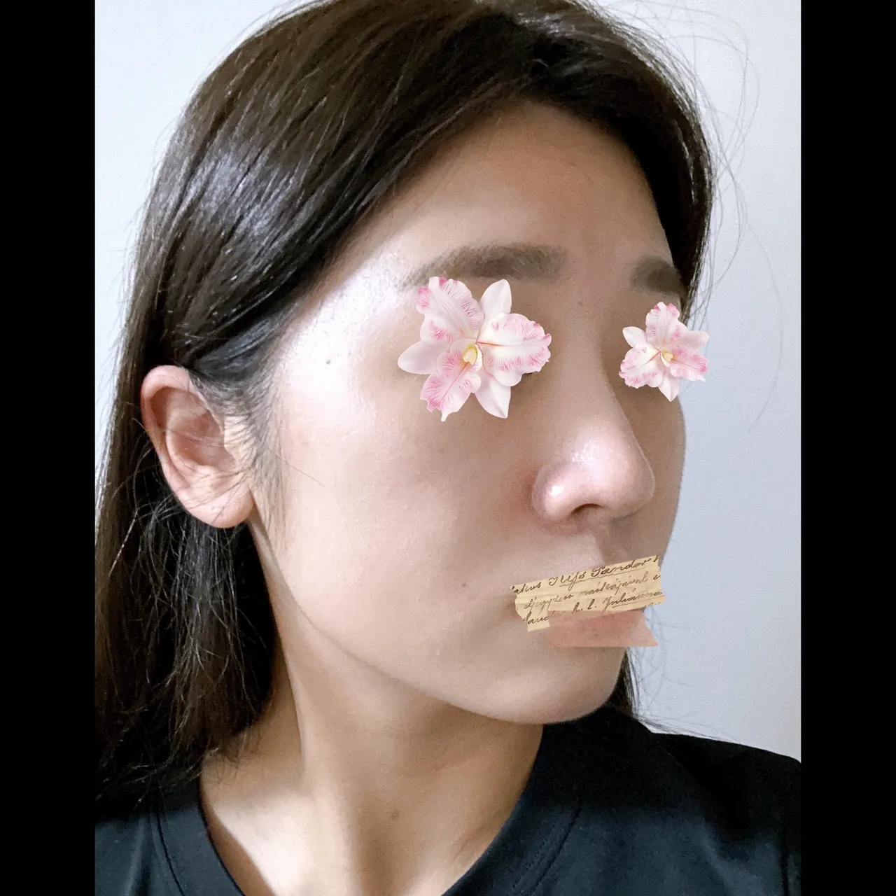 Low Bridge Nose, Crooked Nose, Hump Nose — Yerom Plastic Surgery 4