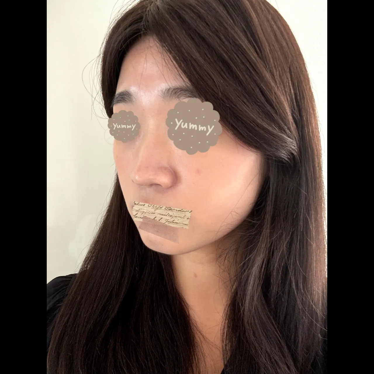Low Bridge Nose, Crooked Nose, Hump Nose — Yerom Plastic Surgery 5