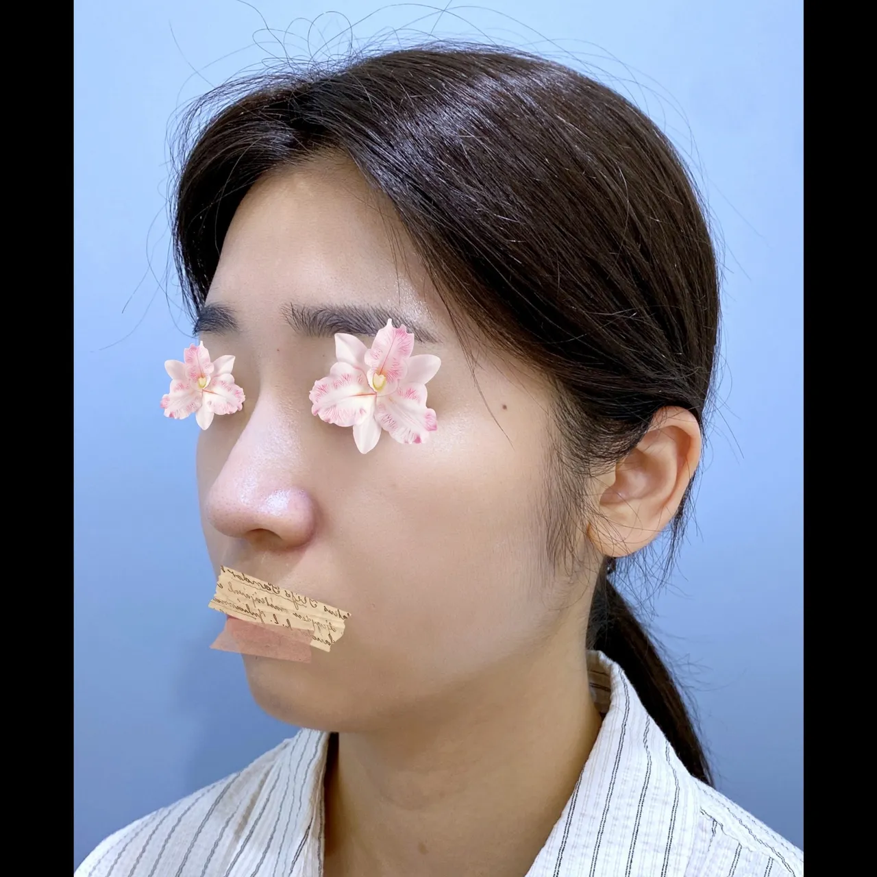 Low Bridge Nose, Crooked Nose, Hump Nose — Yerom Plastic Surgery 6