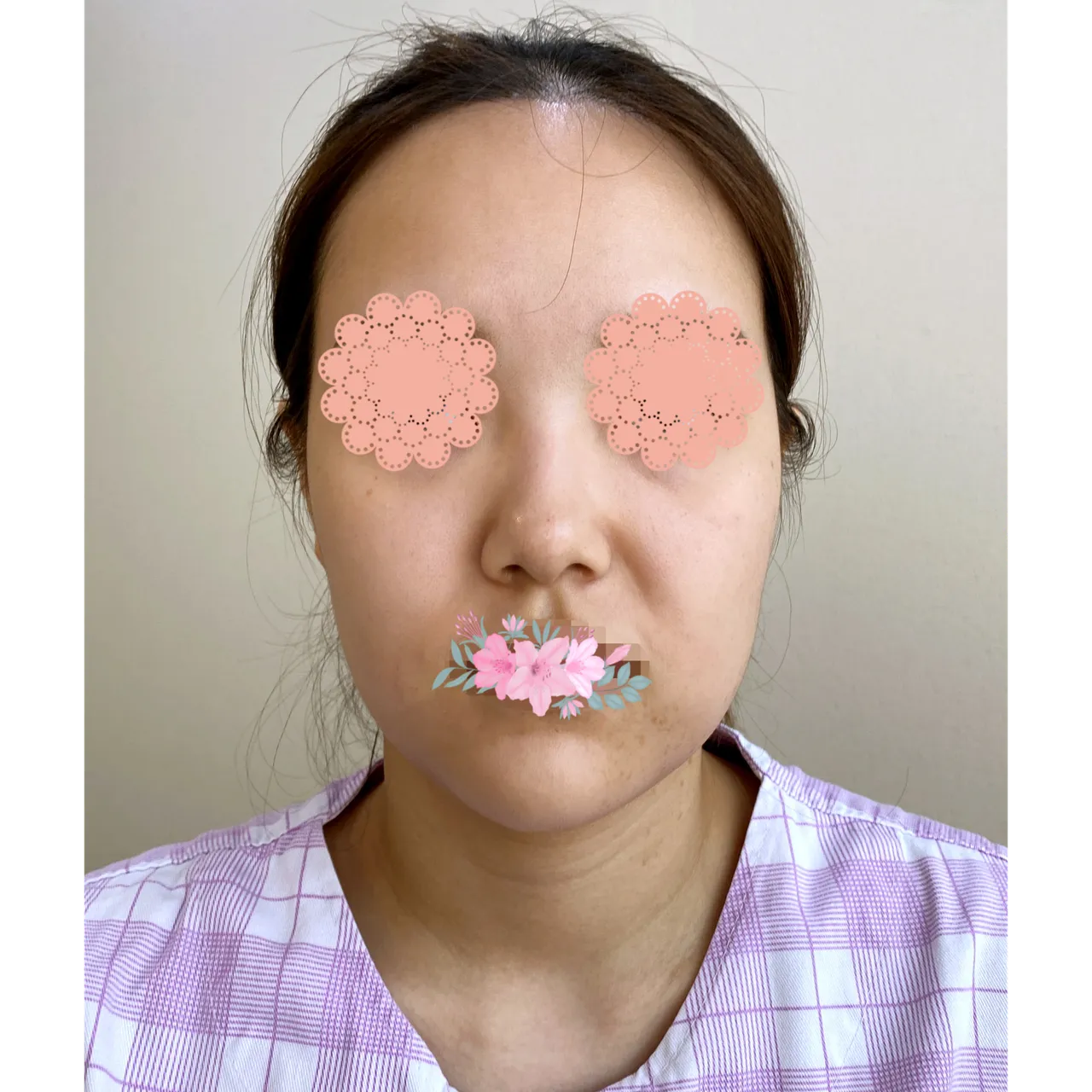 Low Bridge Nose — Yerom Plastic Surgery 1