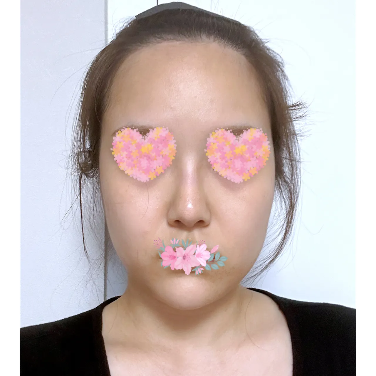 Low Bridge Nose — Yerom Plastic Surgery 2