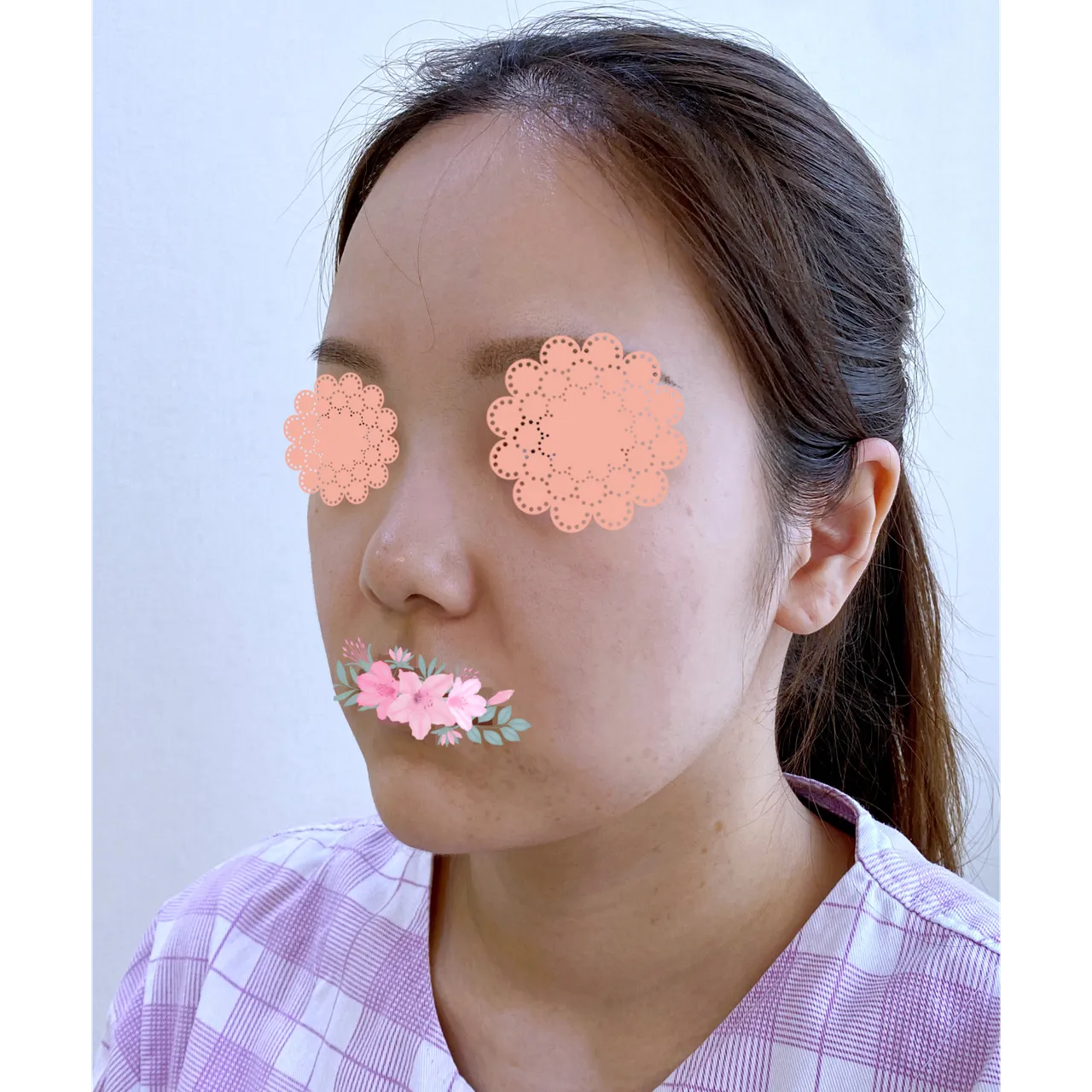 Low Bridge Nose — Yerom Plastic Surgery 3