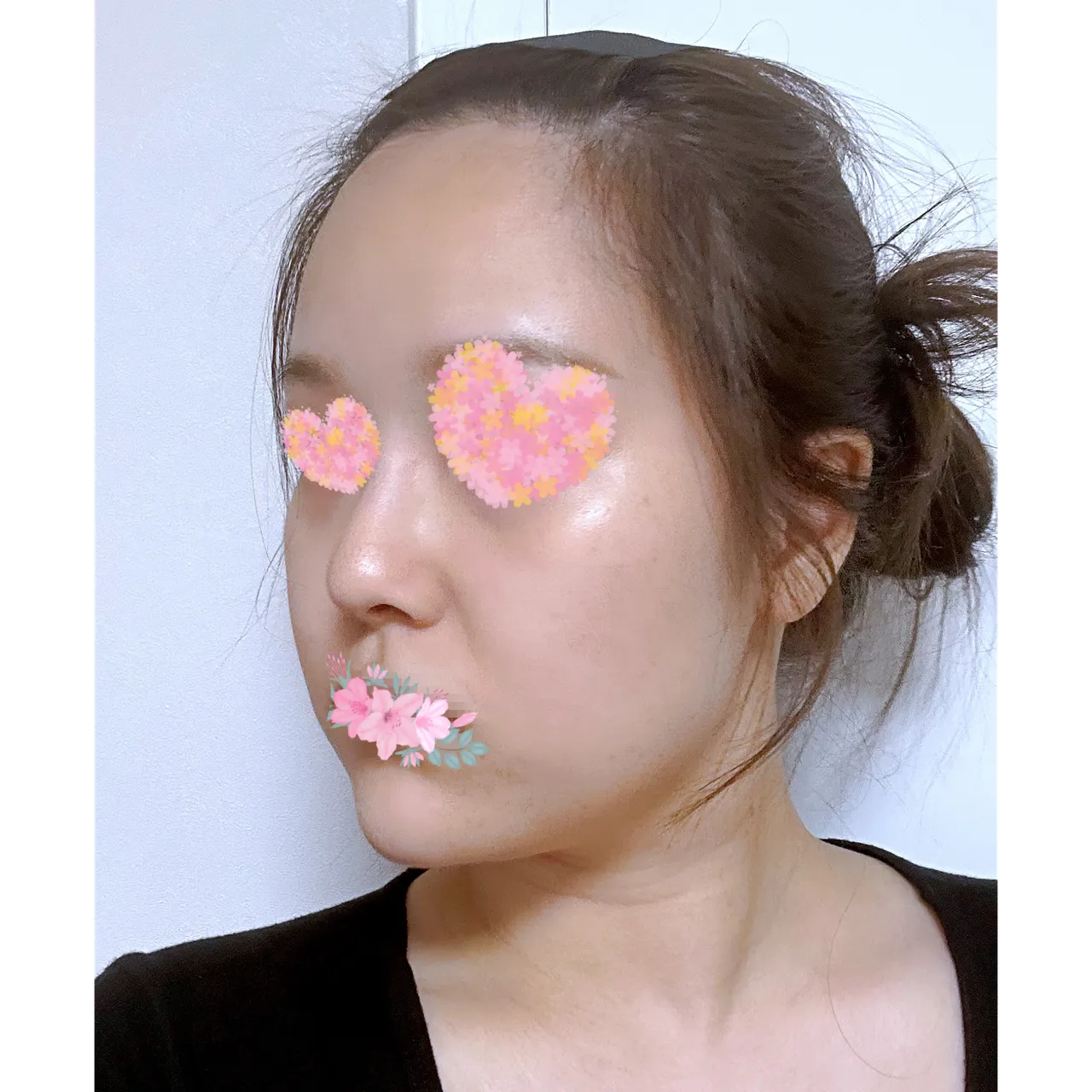 Low Bridge Nose — Yerom Plastic Surgery 4