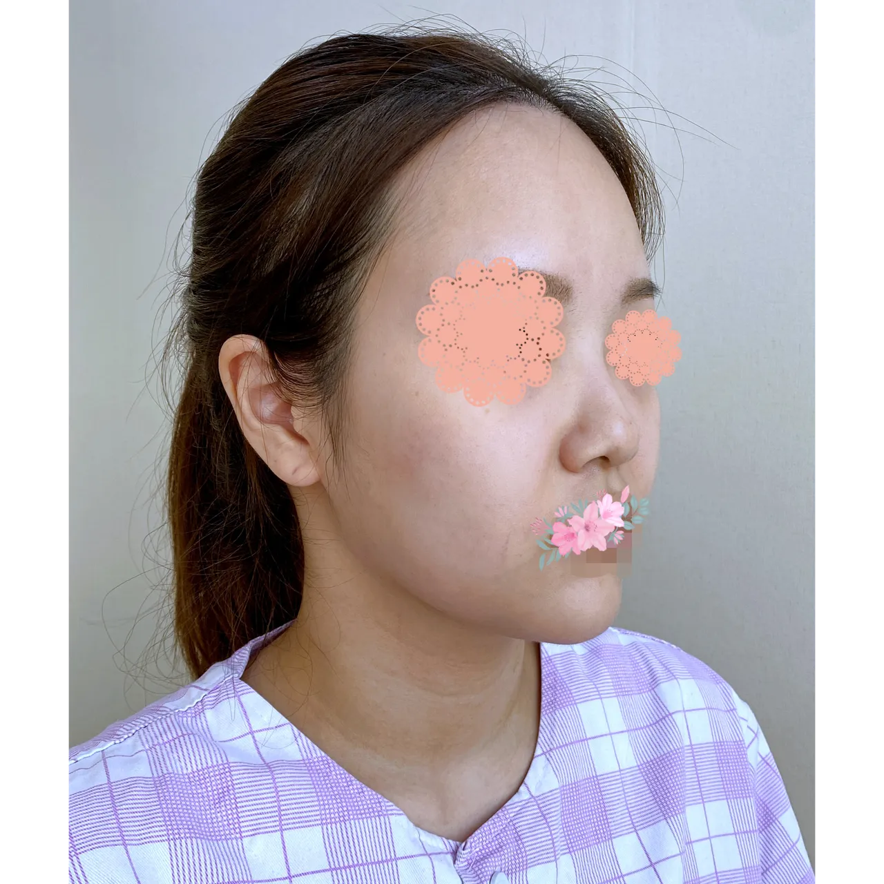 Low Bridge Nose — Yerom Plastic Surgery 5