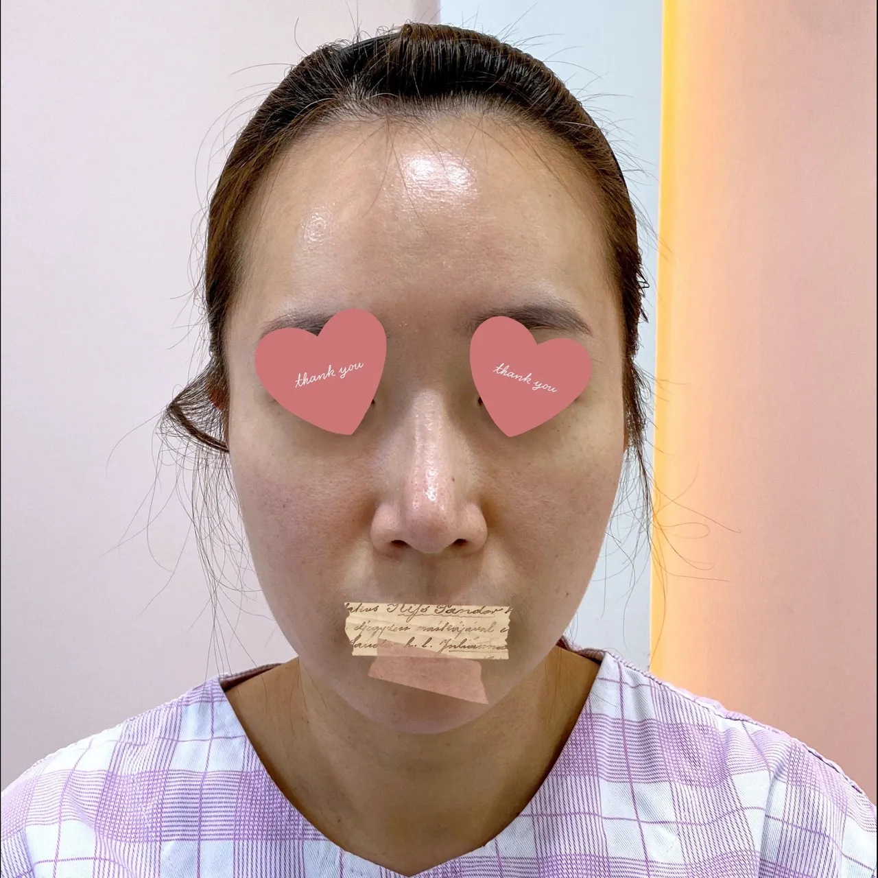 Rhinoplasty Revision — Yerom Plastic Surgery 1