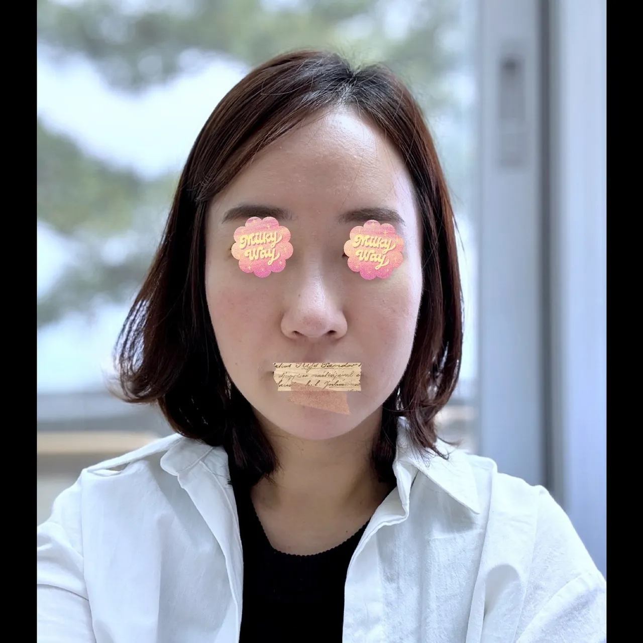Rhinoplasty Revision — Yerom Plastic Surgery 3