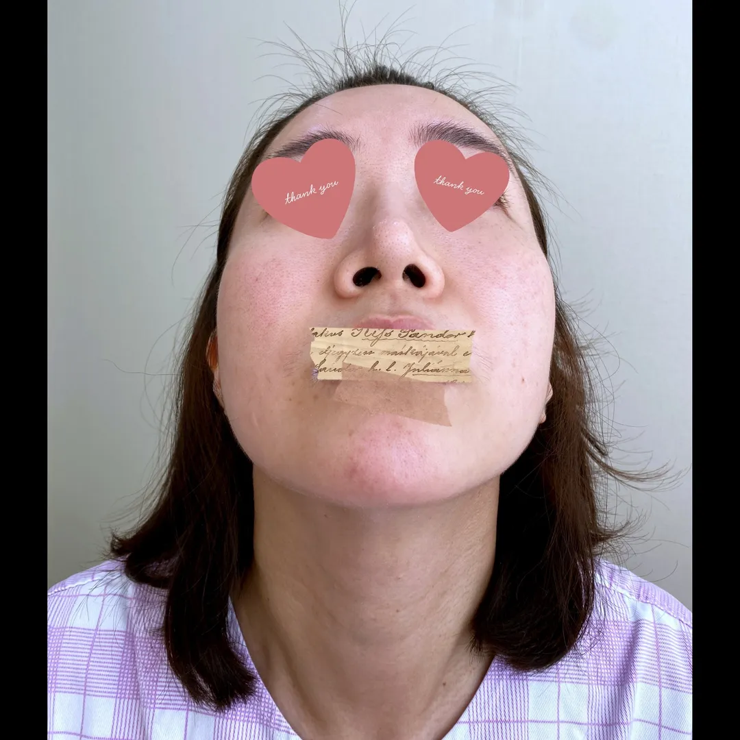 Rhinoplasty Revision 2