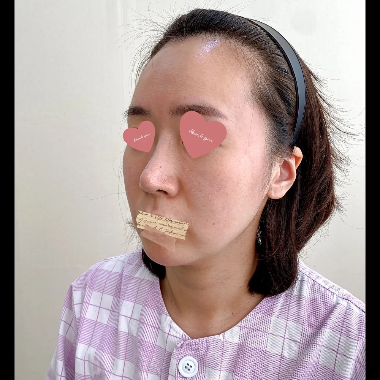 Rhinoplasty Revision — Yerom Plastic Surgery 4