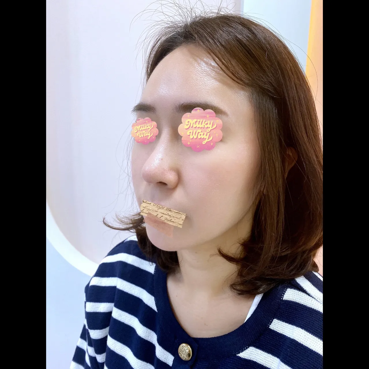 Rhinoplasty Revision — Yerom Plastic Surgery 5