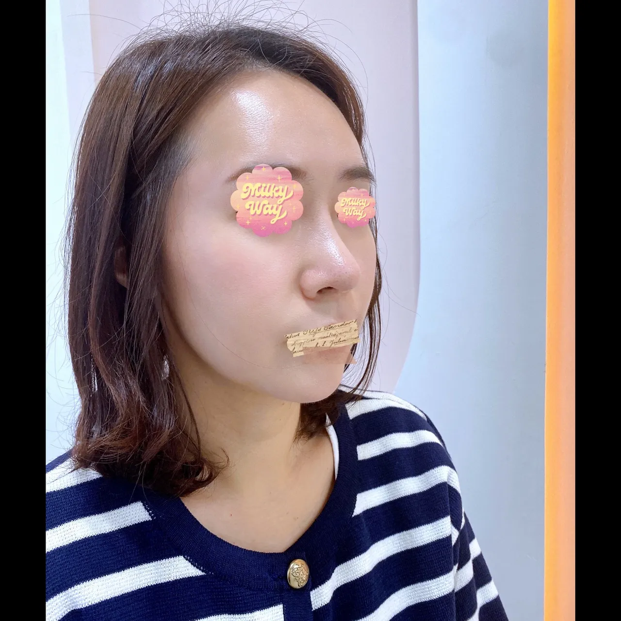 Rhinoplasty Revision — Yerom Plastic Surgery 6