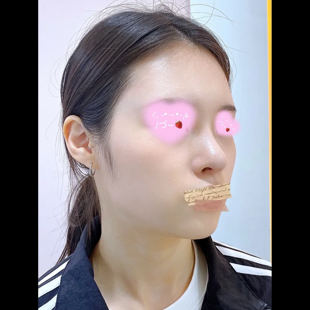 Rhinoplasty Revision 2