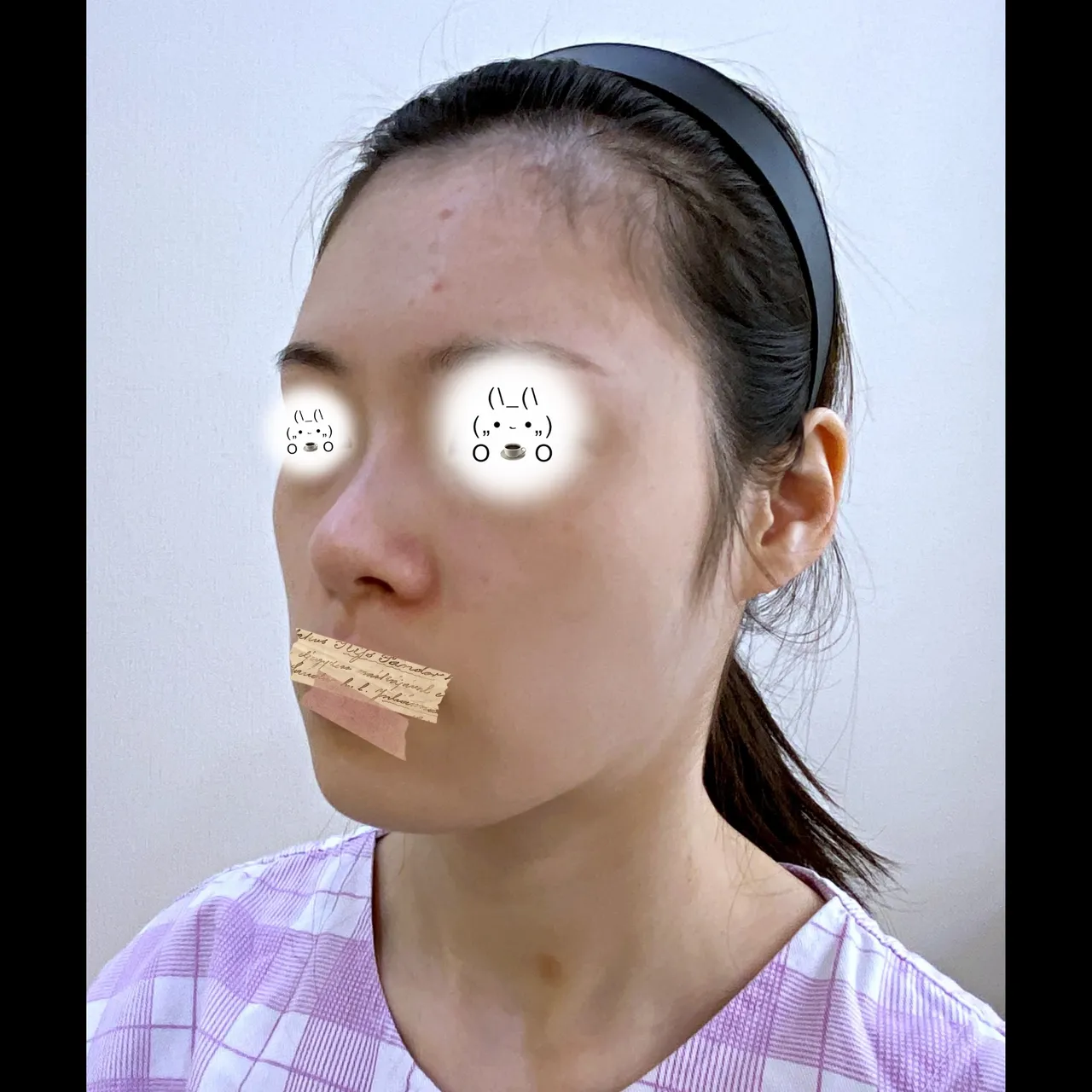 Rhinoplasty Revision — Yerom Plastic Surgery 3