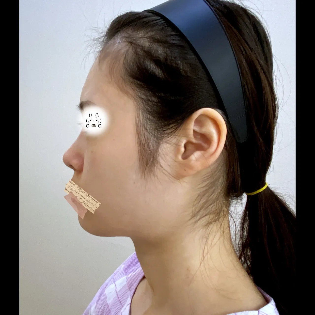 Rhinoplasty Revision — Yerom Plastic Surgery 5