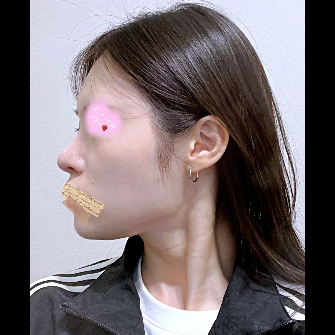 Rhinoplasty Revision — Yerom Plastic Surgery 6